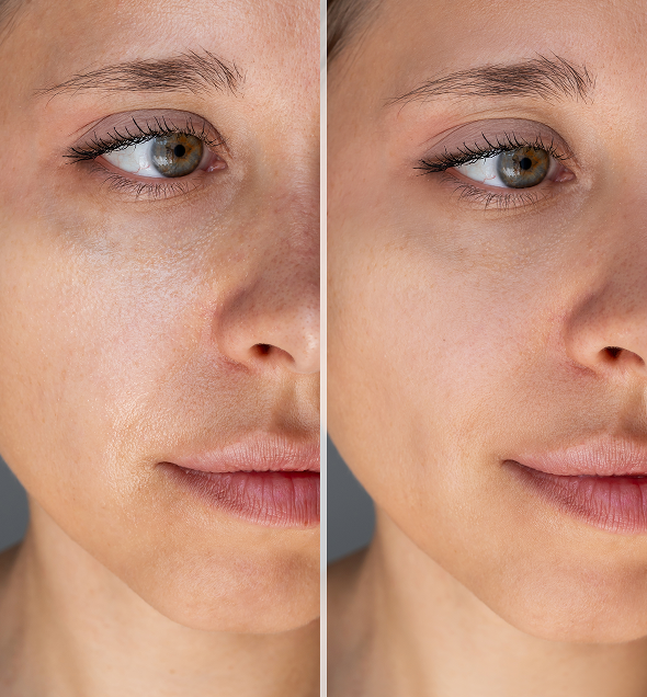 Woman's face before and after treatment for acne