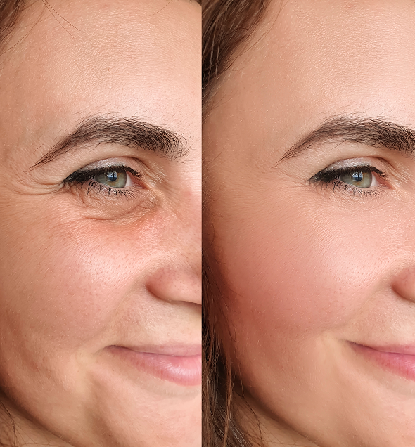 Woman's face before and after using a concealer to reduce wrinkles and dark circles around her eyes