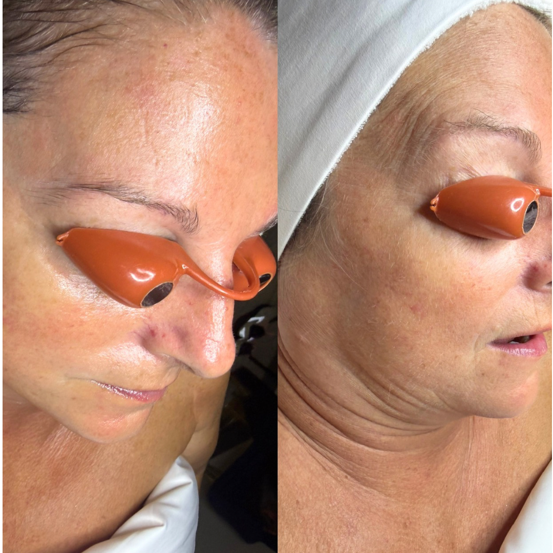 Aging and glow facial before and after