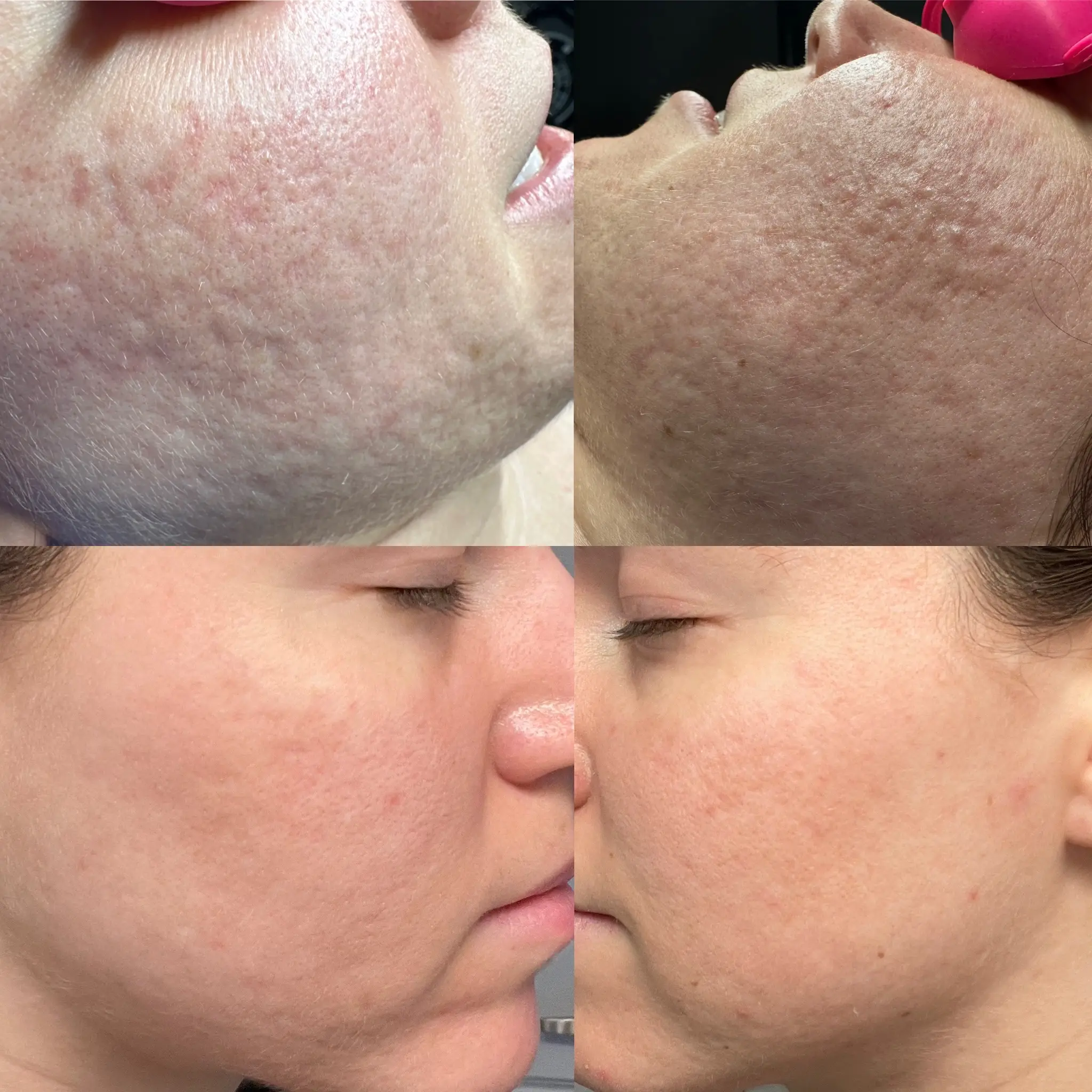 before and after of scarring