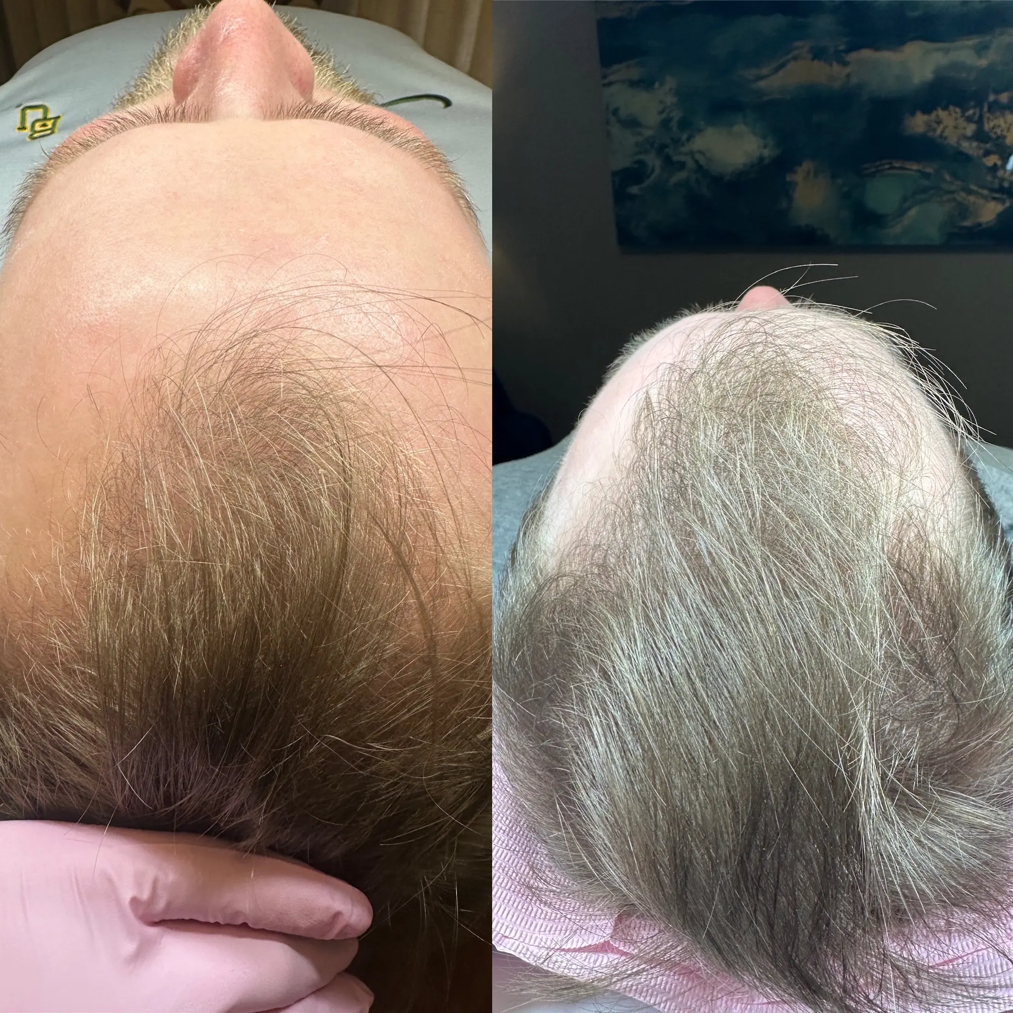 Procell hair treatment before and after