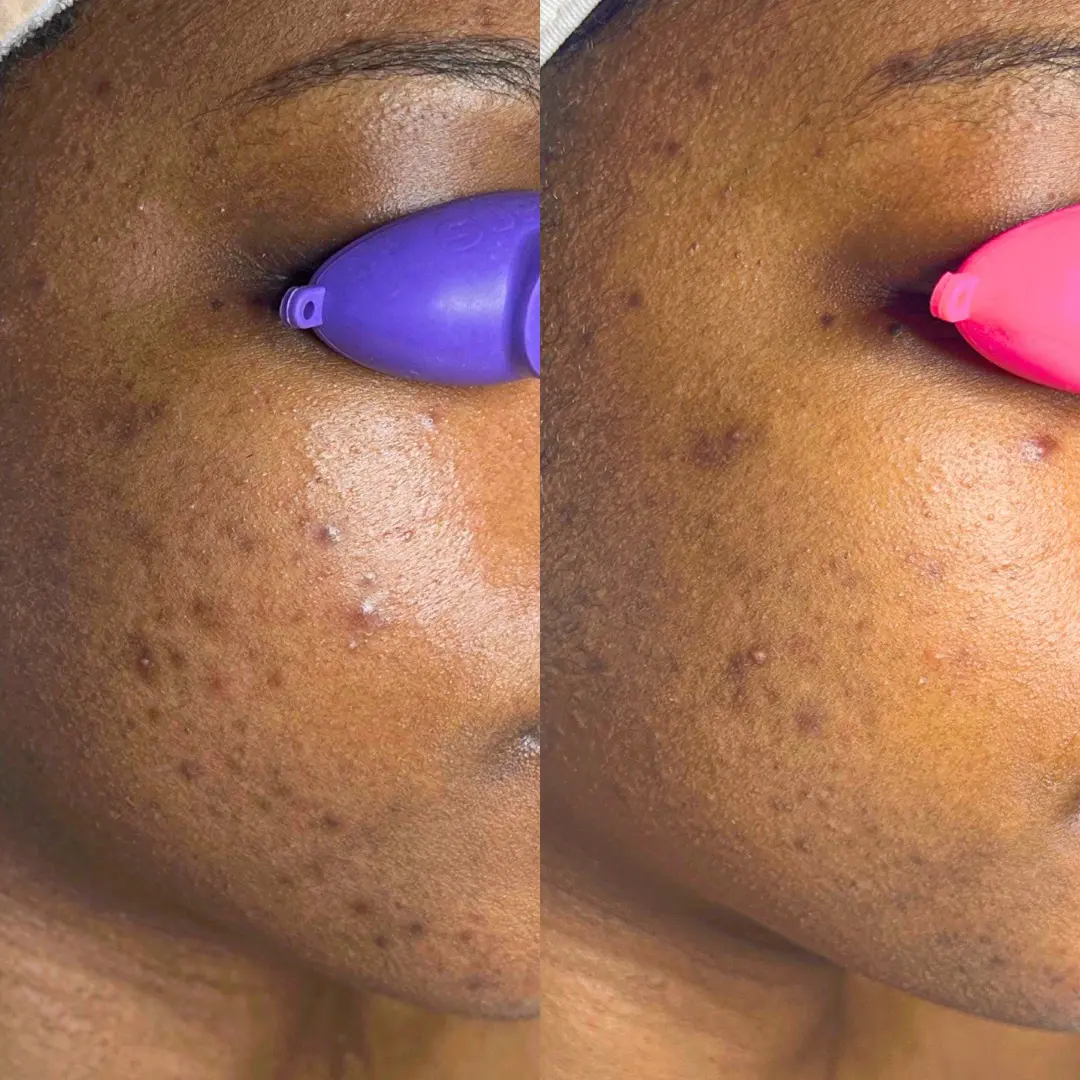 Acne Before and after