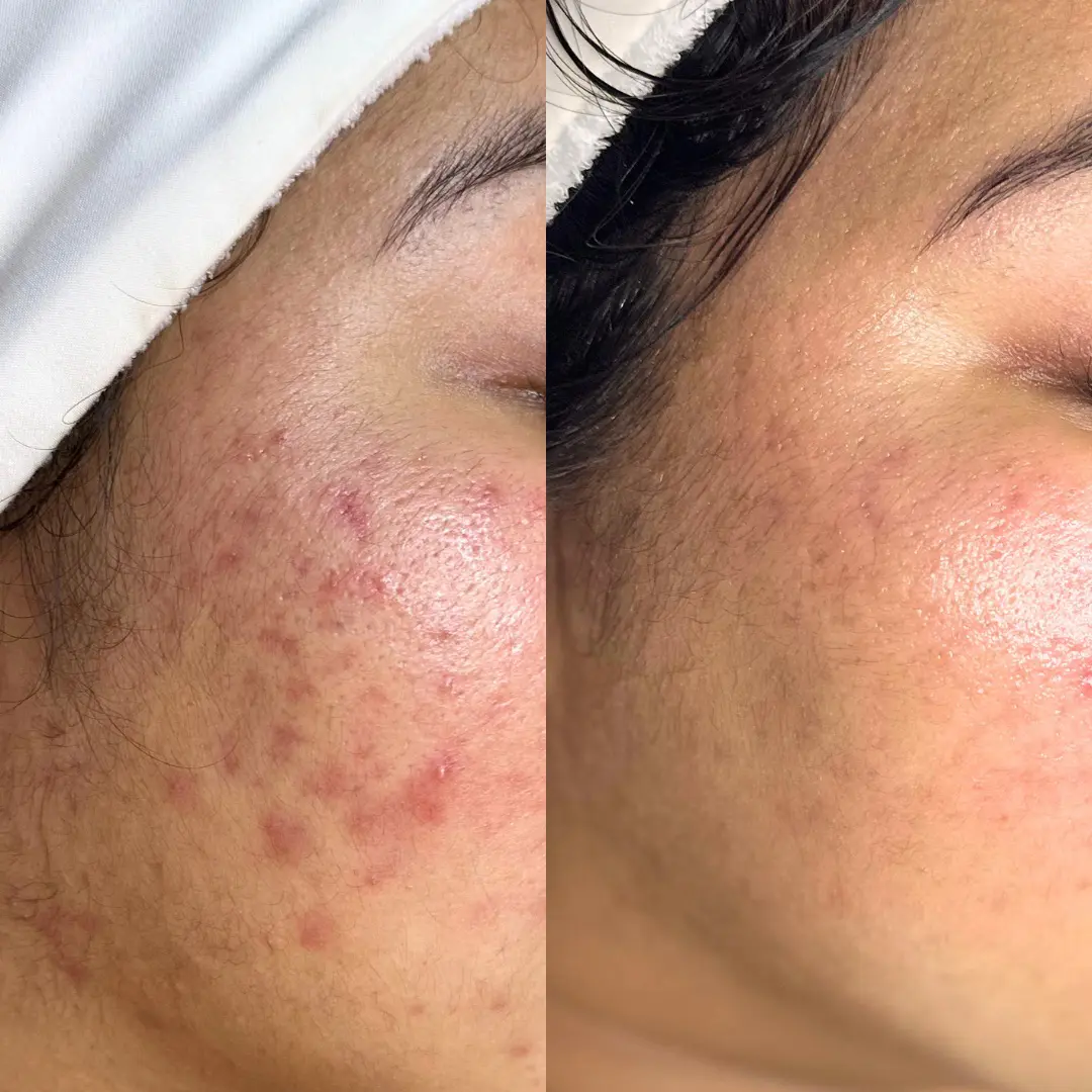 Acne progress Before and after